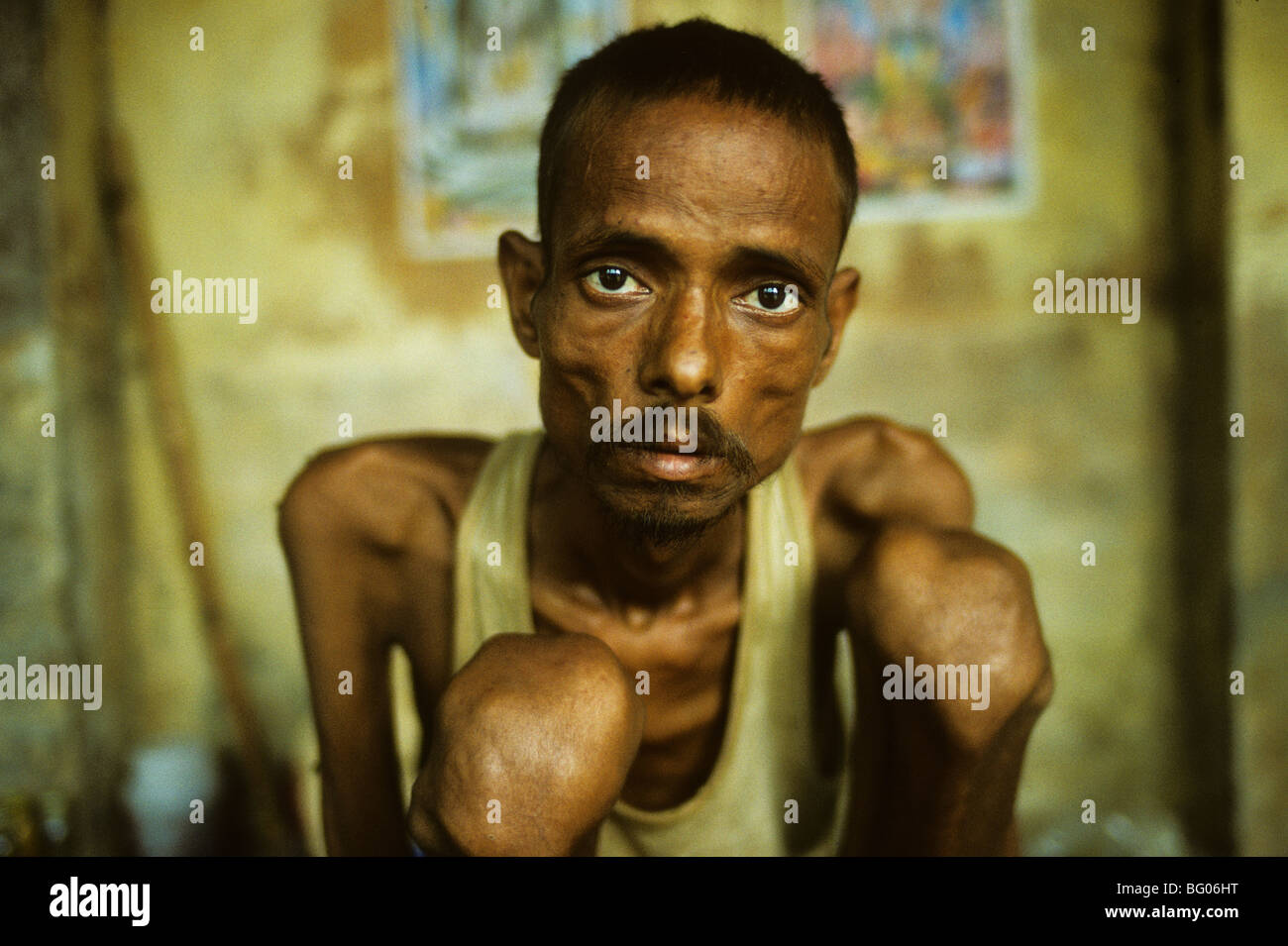 Portrait of an aids victim, Madurai, India Stock Photo