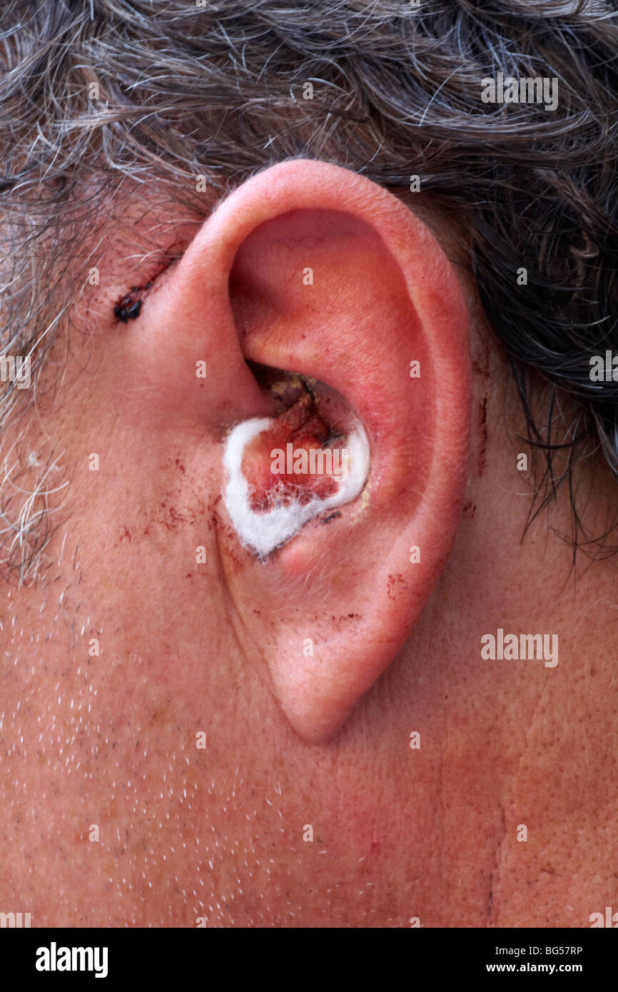 Bleeding ear hires stock photography and images Alamy