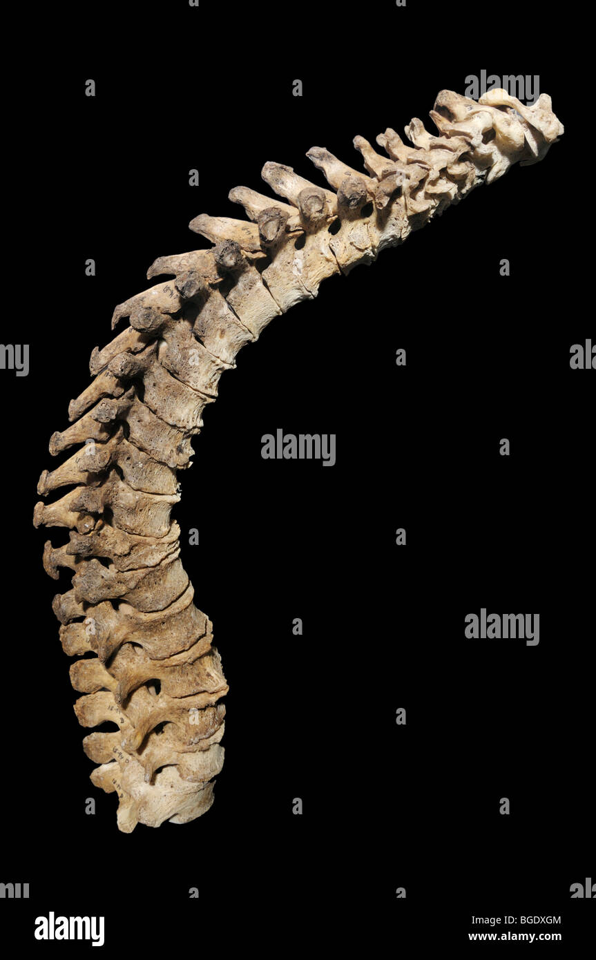 Kyphosis, abnormal curvature of the spine, possibly caused by Rickets