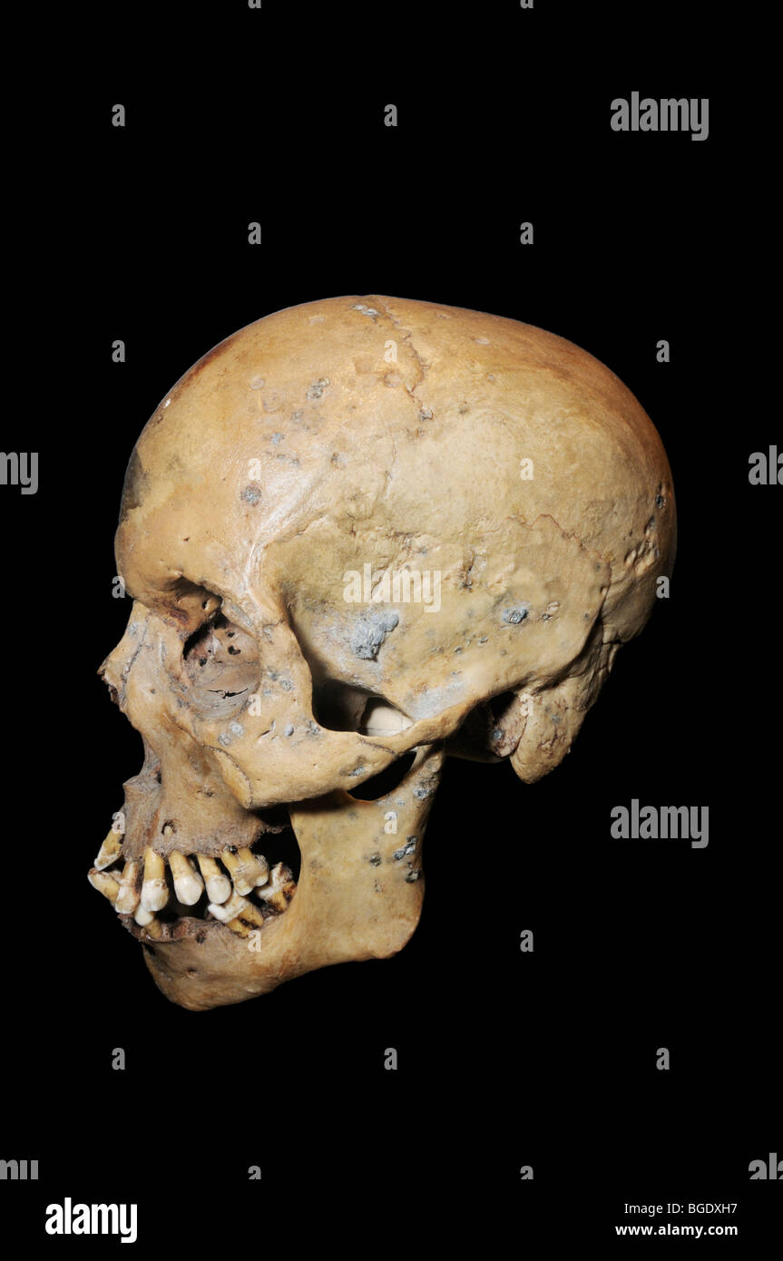 Skull of person killed by shotgun blast to the head.  The flattened grey lead buckshot pellets are embedded in the skull Stock Photo