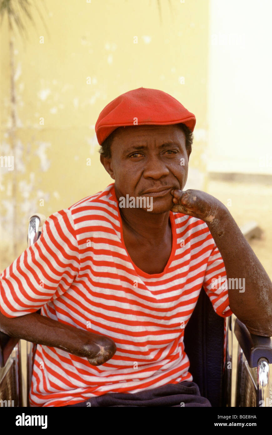 A resident in a leper colony, Luanda, Angola.  He has lost most of his fingers. Stock Photo