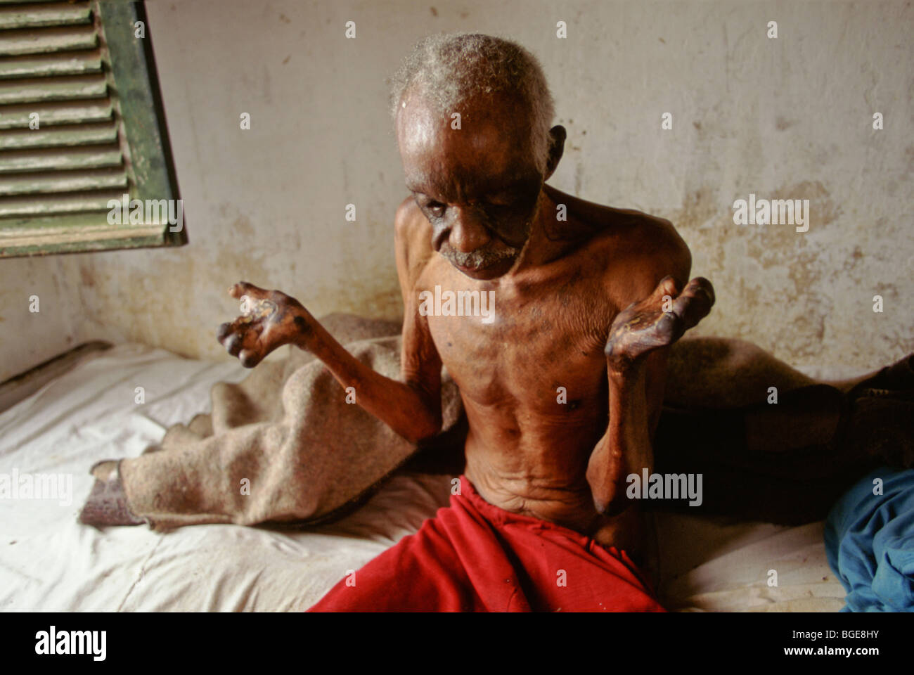 A resident in a leper colony, Luanda, Angola.  He has already lost his fingers. Stock Photo