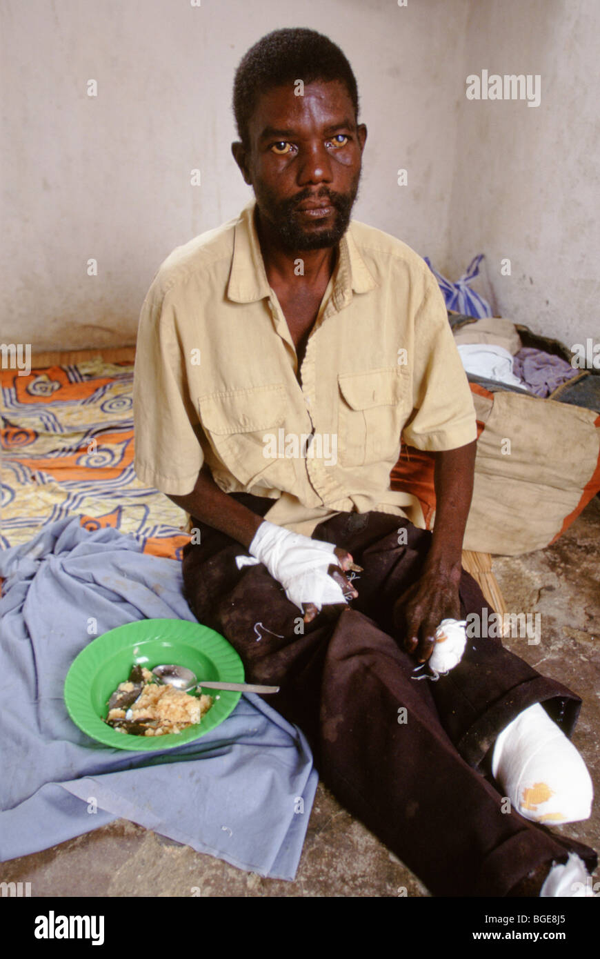 A resident in a leper colony, Luanda, Angola.  He is badly affected by leprosy. Stock Photo
