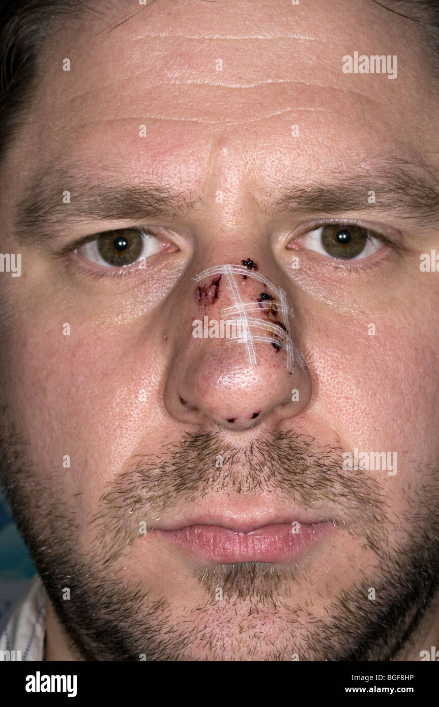 Man With Steri Strips On His Nose After A Dog Bite On The Nose Stock Photo Alamy