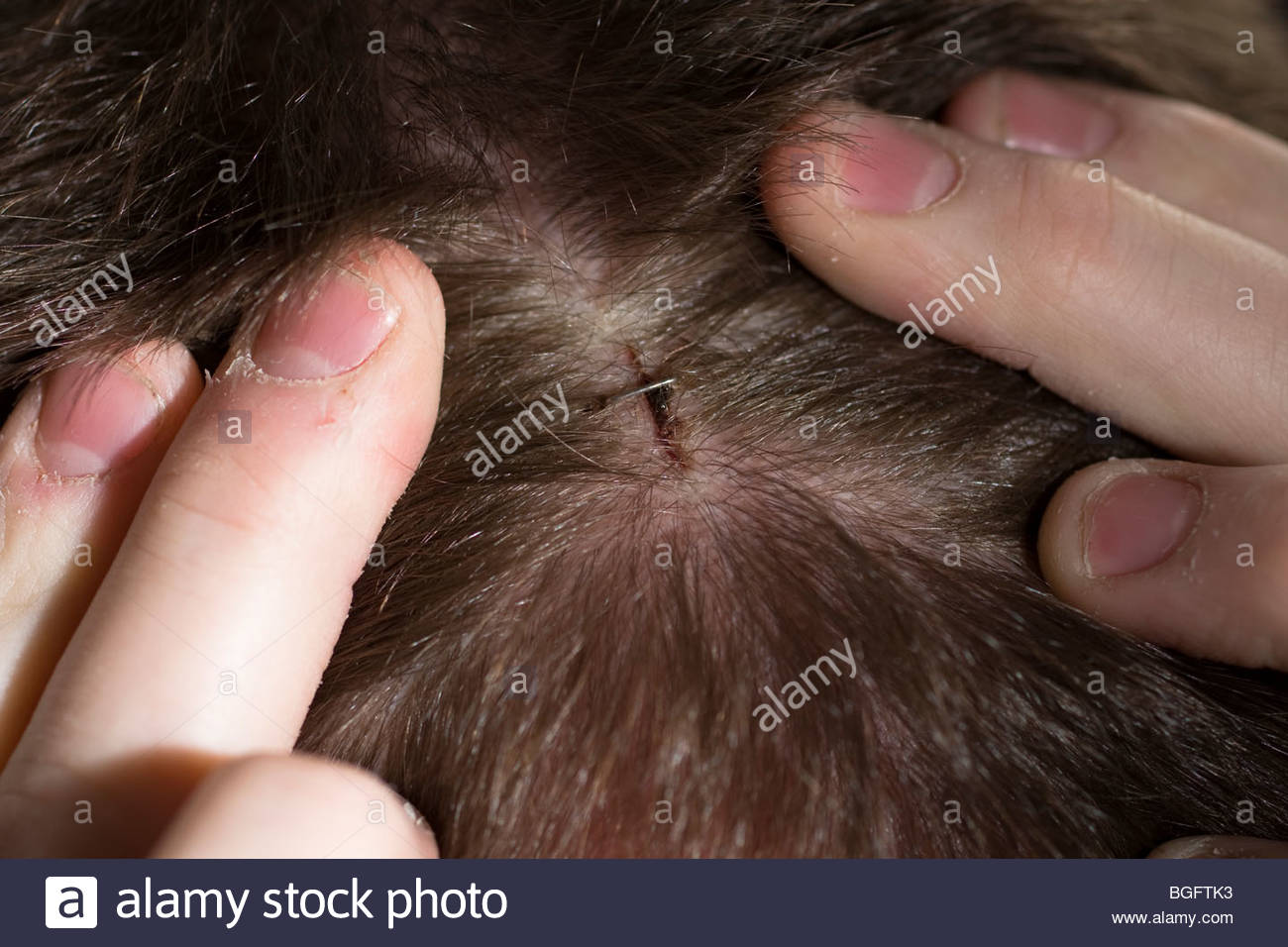 Head Wound High Resolution Stock Photography and Images Alamy
