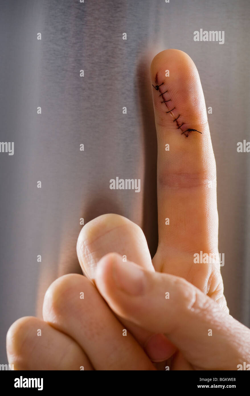 Closeup of an extended index finger with a cut and seven stitches in it. Stock Photo