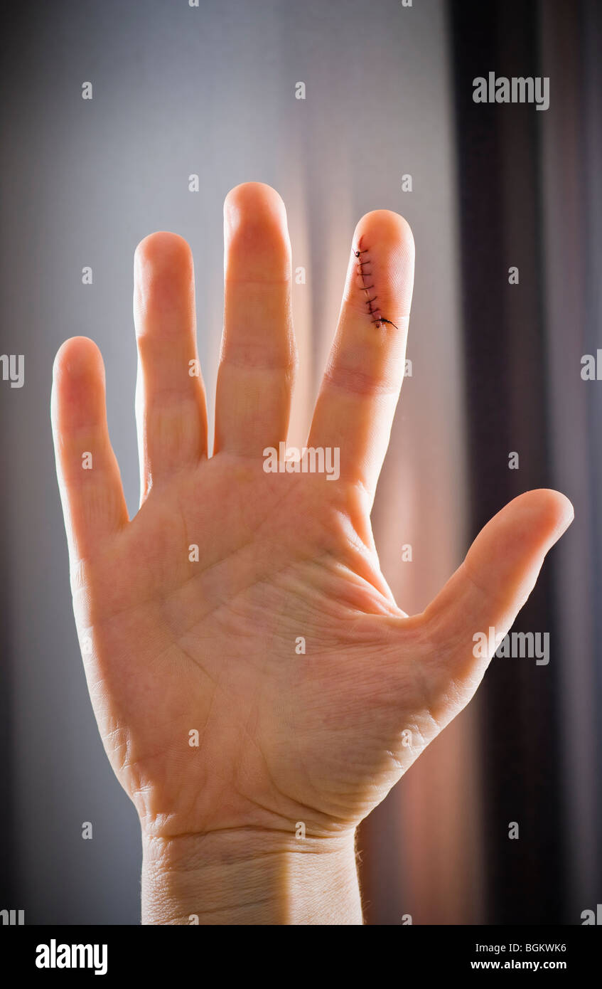 A womans hands with a stitched up cut on the index finger. Stock Photo