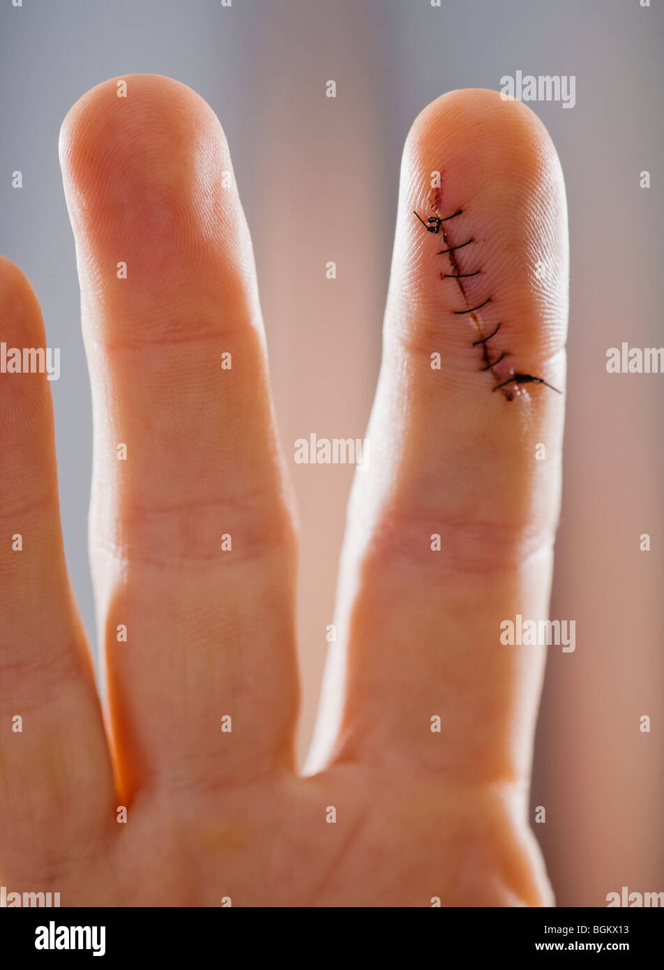 Closeup of an index finger with a stitched up cut. Stock Photo