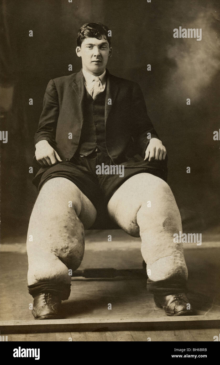 Man with Elephantiasis or Lymphatic Filariasis Stock Photo