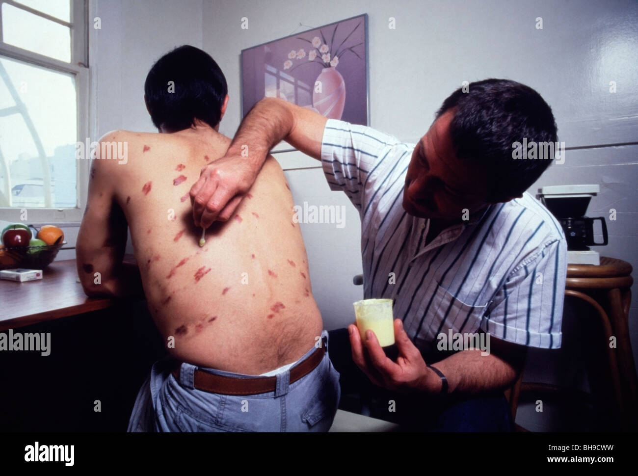 Applying DNCB lotion to an HIV/AIDS patient with Kaposi's Sarcoma lesions in San Francisco, California Stock Photo