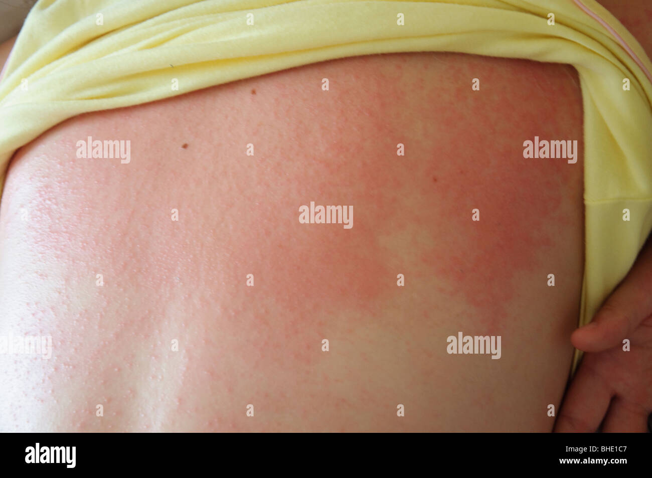 Heat rash hi-res stock photography and images - Alamy
