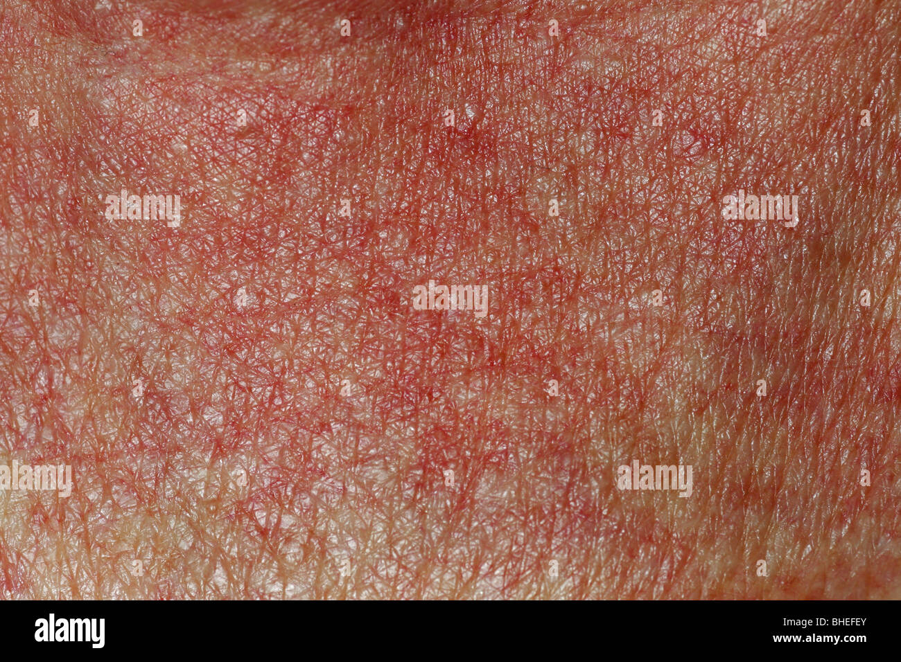 Skin Rash or dermatitis on a sick person Stock Photo