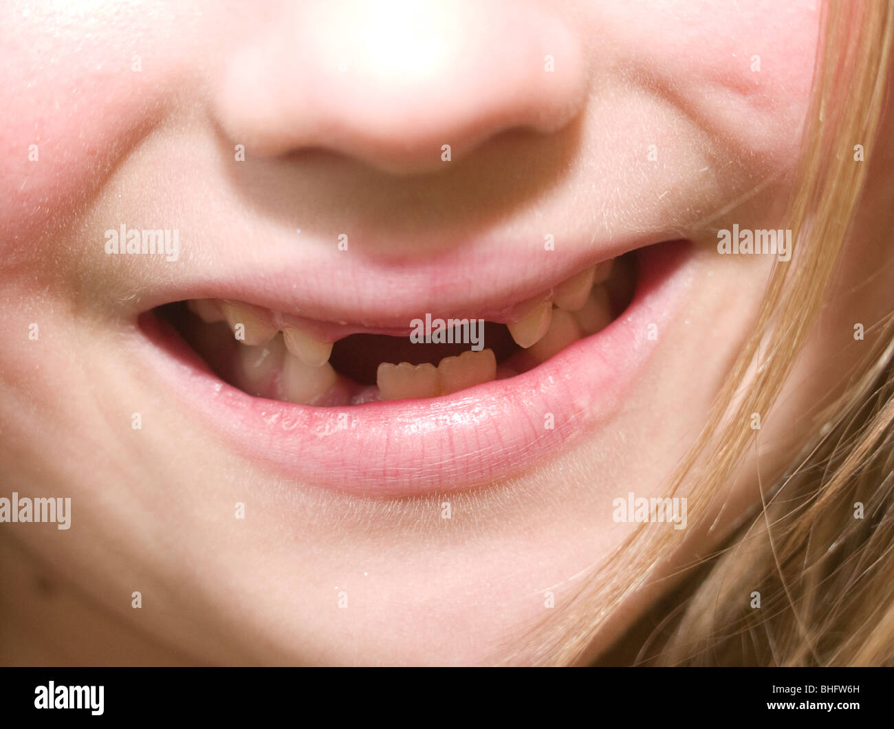 Girl with missing teeth Stock Photo