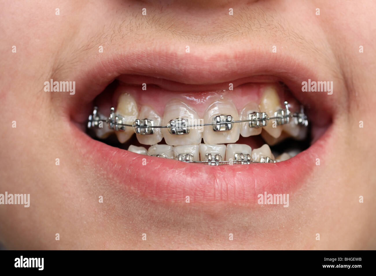 closeup view on children teeth with braces Stock Photo Alamy
