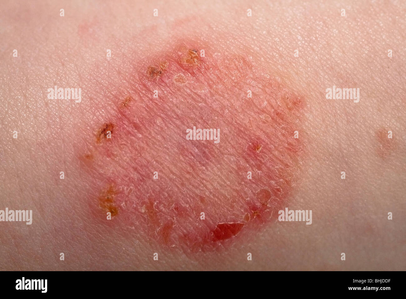 Ringworm fungus infection tinea corporis on young boy's arm Stock Photo