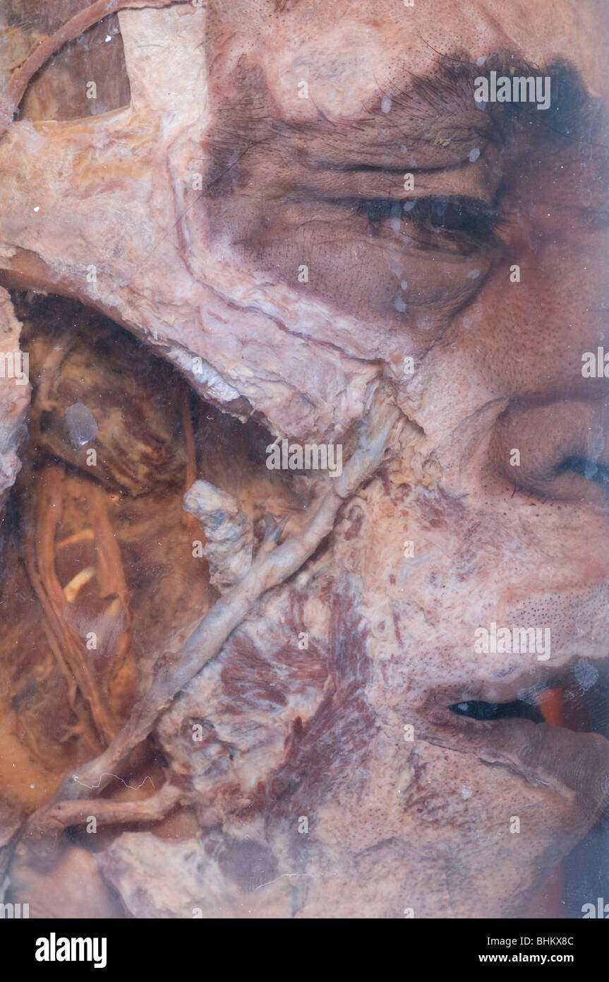 Closeup of a dead man's head preserved in a glass jar Stock Photo
