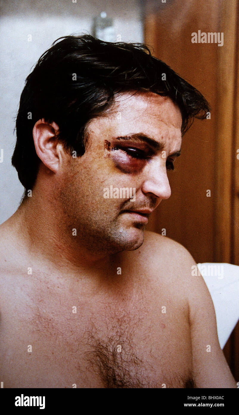 Gary Mabbutt Football shows off bruising on face after having jaw