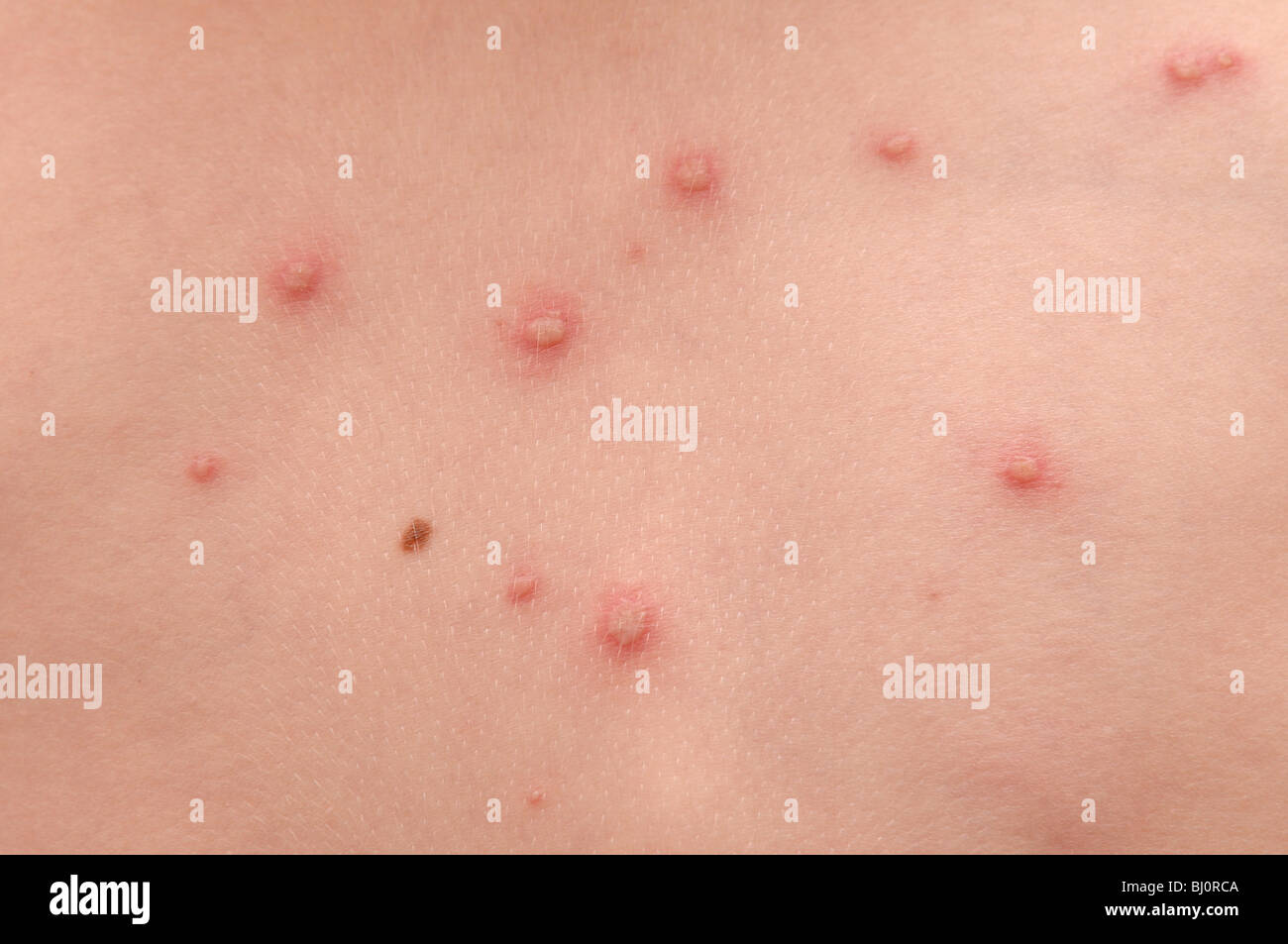 Chickenpox High Resolution Stock Photography and Images Alamy