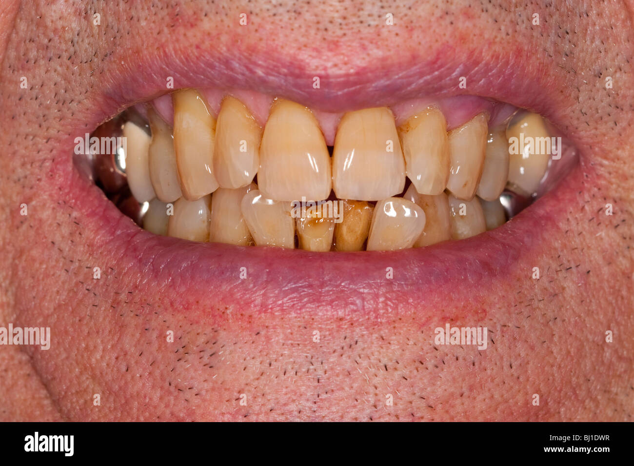 How Do You Know if Your Tooth is Rotten?