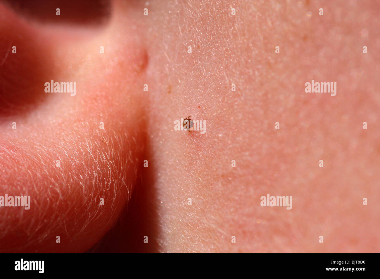 A tick on a child's cheek Stock Photo