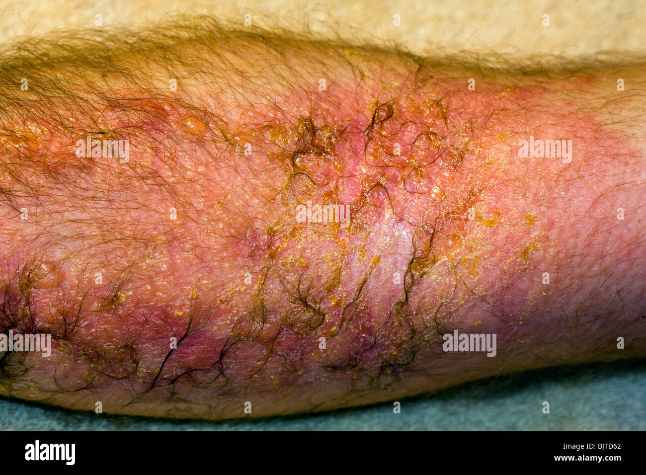 Severe poison ivy rash/reaction. Stock Photo