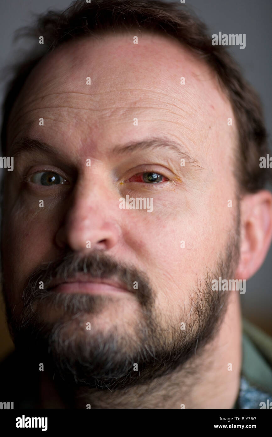 Portrait of man having undergone eye operation Stock Photo