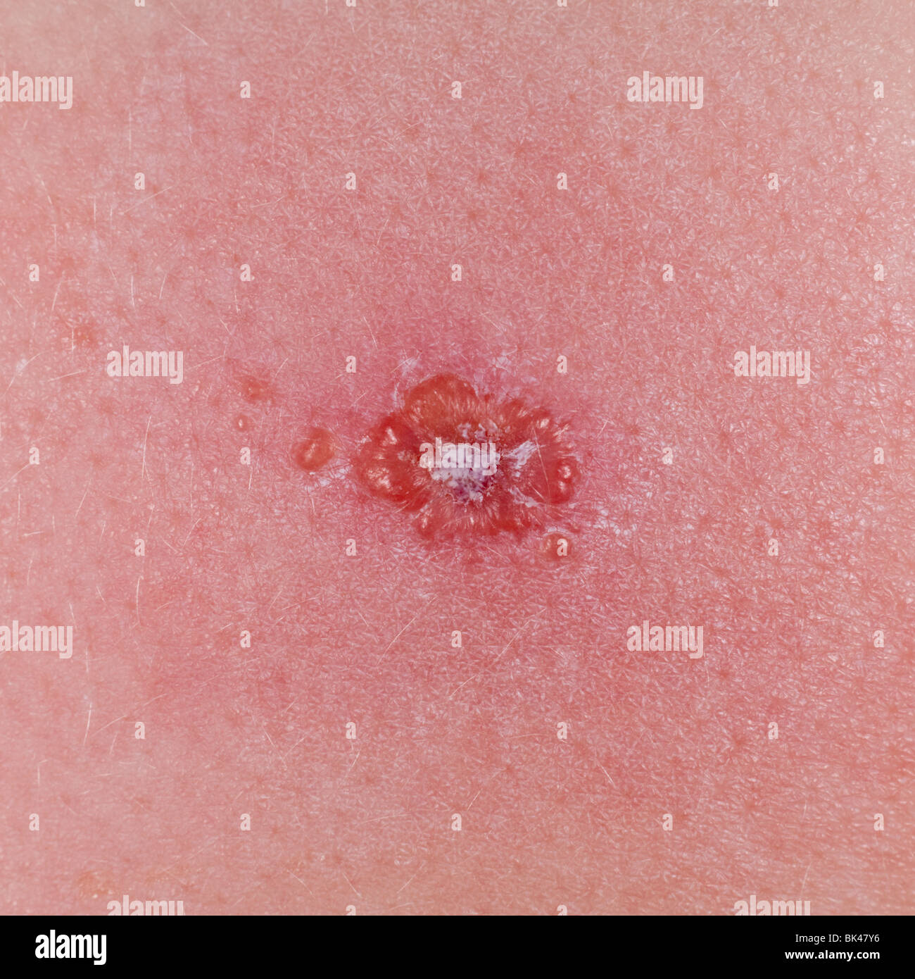 Chickenpox rash hi-res stock photography and images - Alamy