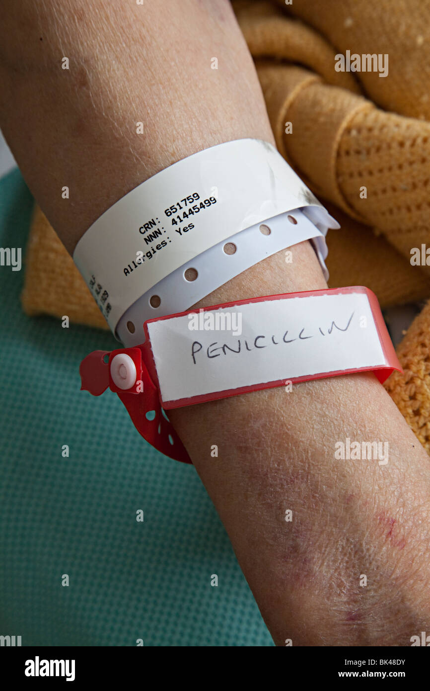 Patient in hospital with allergy warning information on wrist bands Nevill Hall Hospital Abergavenny Wales UK Stock Photo