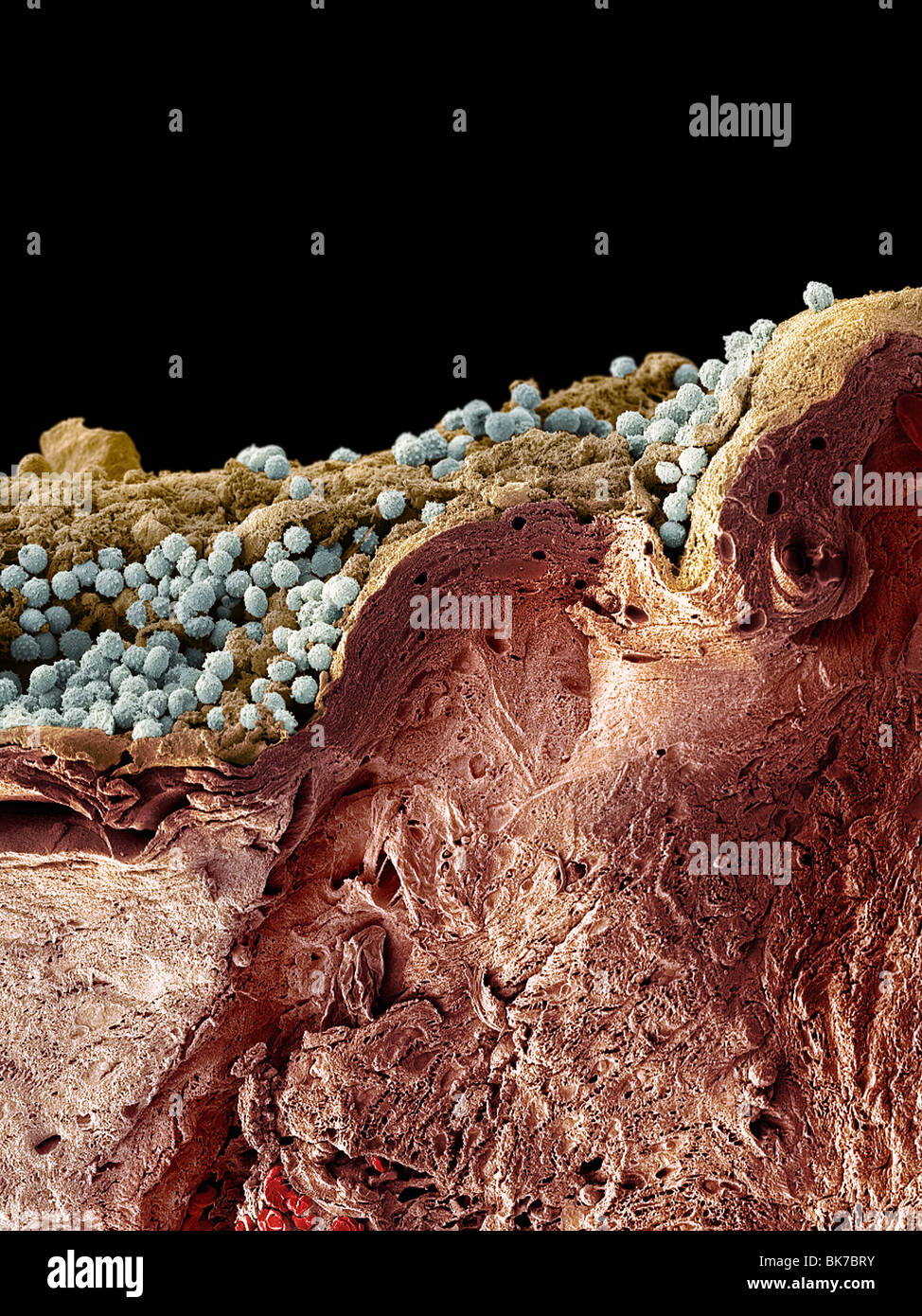 Pyoderma skin disease, SEM Stock Photo