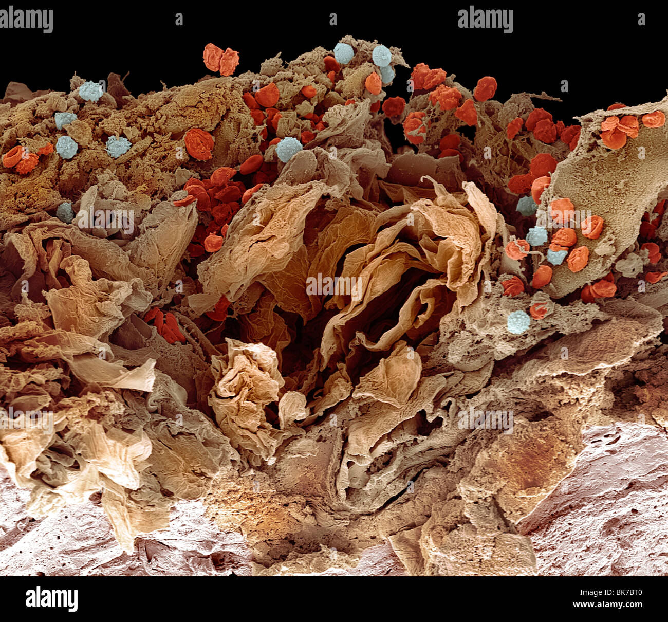 Pyoderma skin disease, SEM Stock Photo