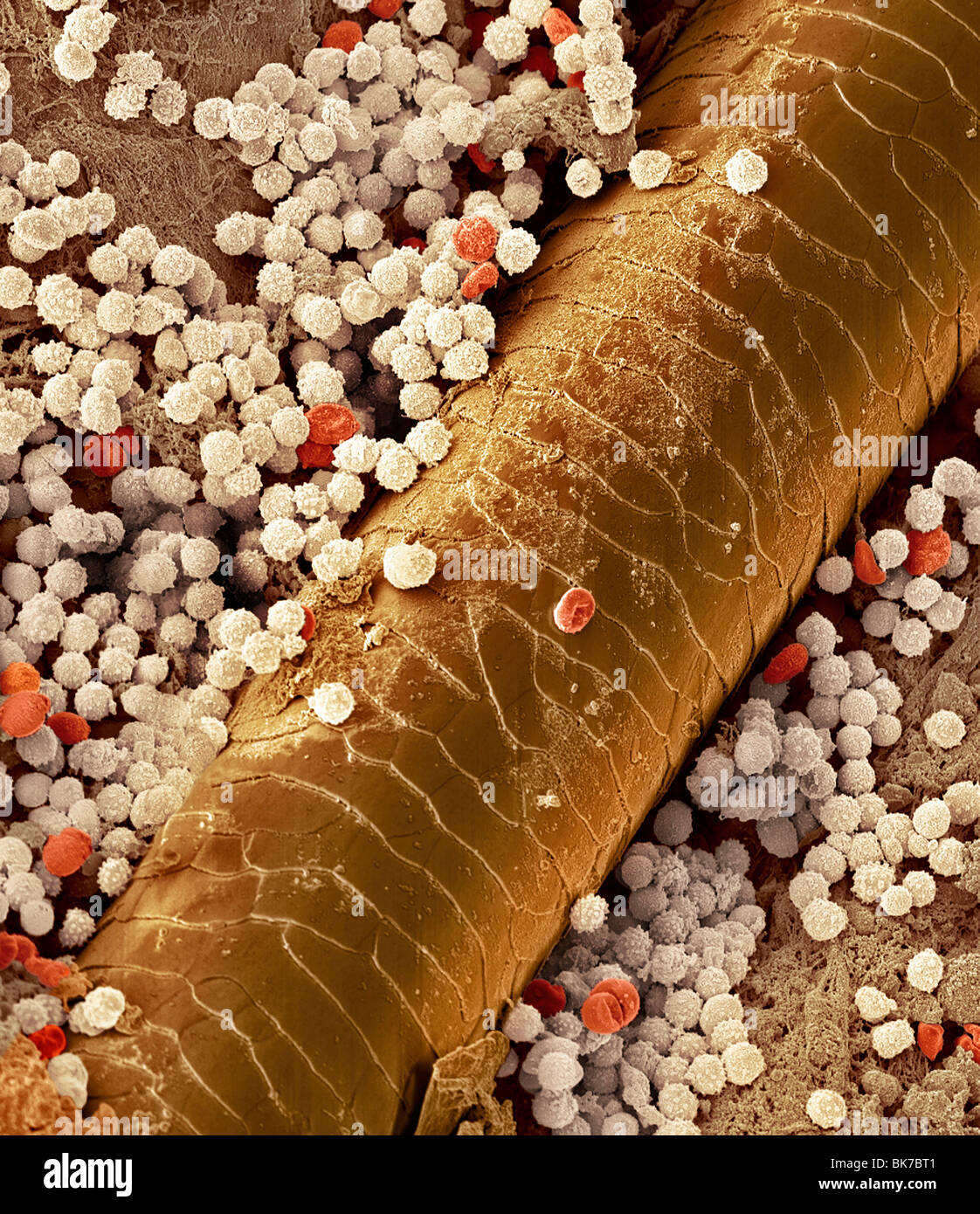 Pyoderma skin disease,SEM Stock Photo