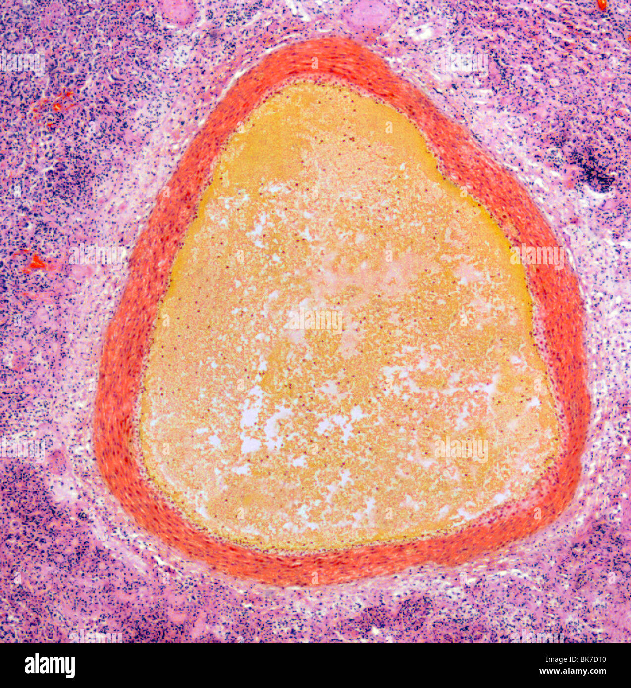 Lung aneurysm, light micrograph Stock Photo Alamy