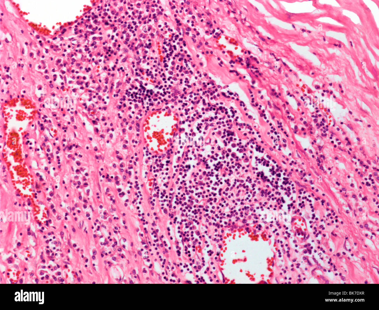 Cardiovascular syphilis, light micrograph Stock Photo