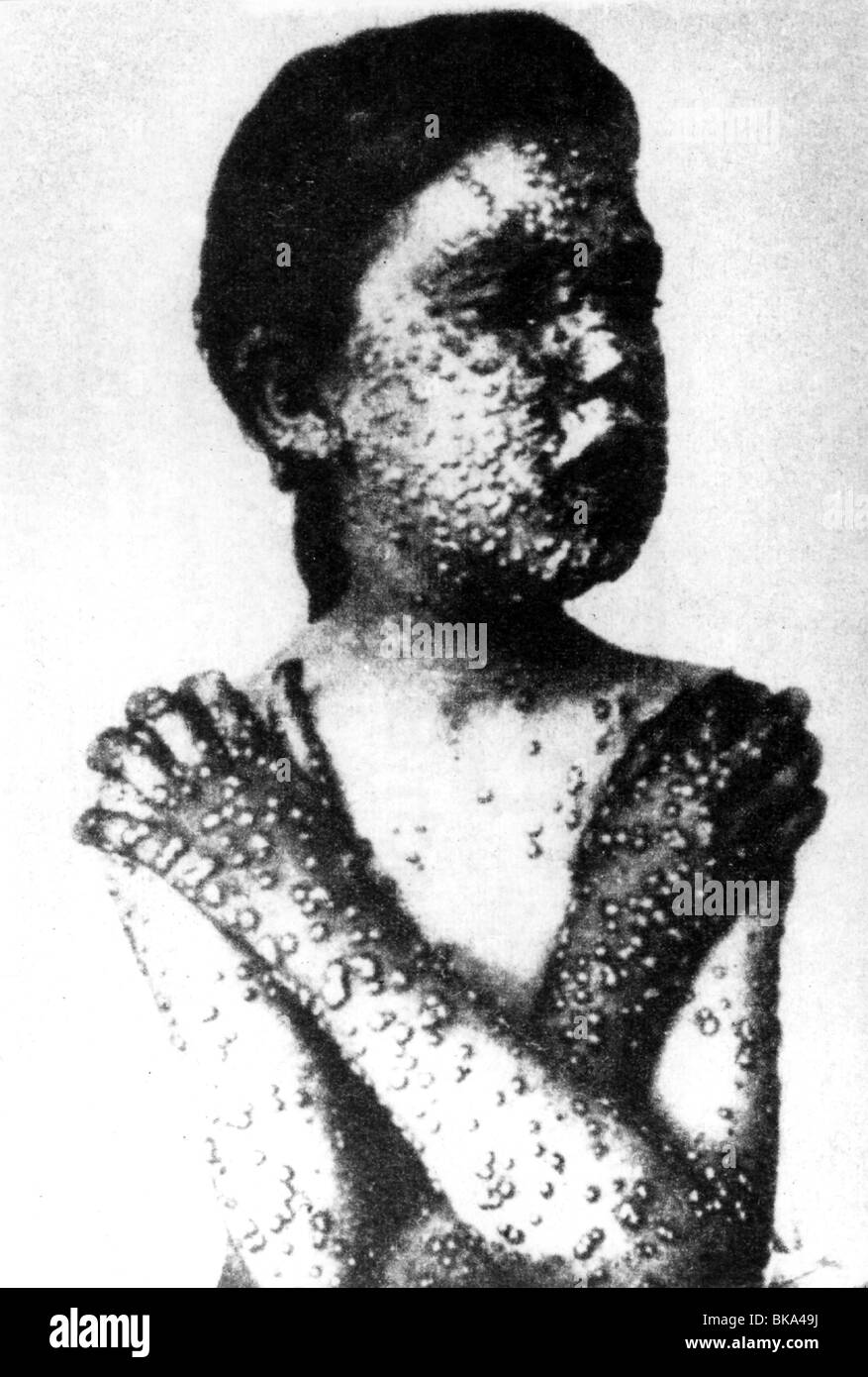medicine, pandemic disease, smallpox, child seized with pox on the hole body, 19th century, historic, historical, variola, disease, illness, diseases, illnesses, deformation, deformations, warp, skin, rash, erupt, pustule, pustules, epidemic, epidemics, symptoms, sign, indication, signs, indications, sick person, sick people, the sick, chronically sick person, the chronically sick people, incurable, Stock Photo