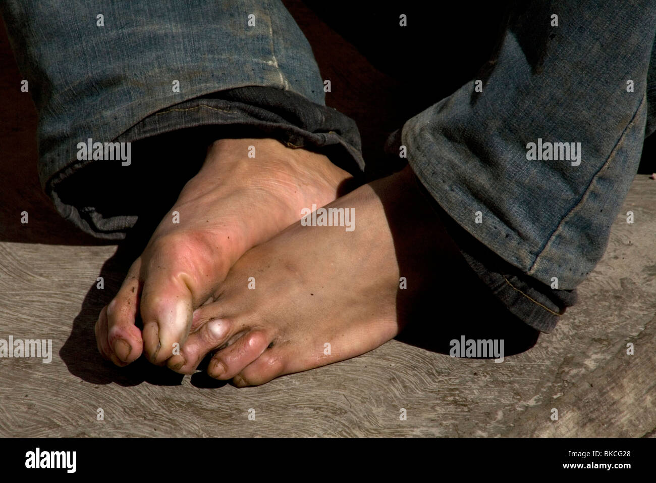 The blistered feet of an undocumented Central American migrant traveling across Mexico to reach United States, Mexico City. Stock Photo