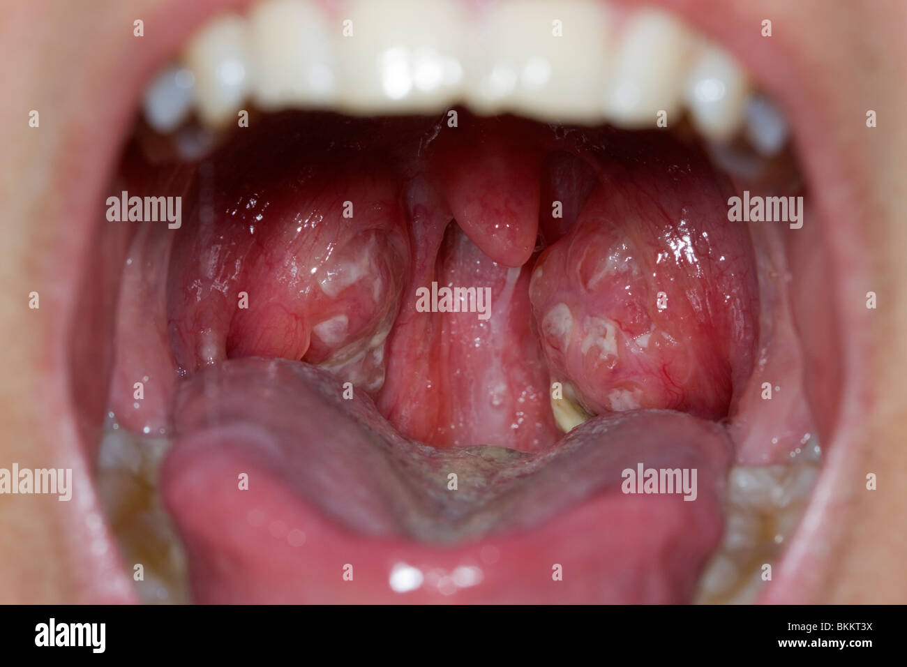 Tonsillitis. Infected, swollen tonsils on a teenage girl. From a virus infection Stock Photo