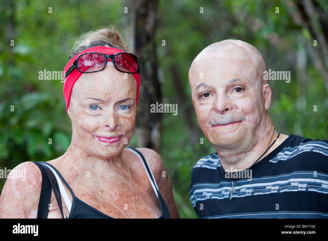 Burn victim hires stock photography and images Alamy