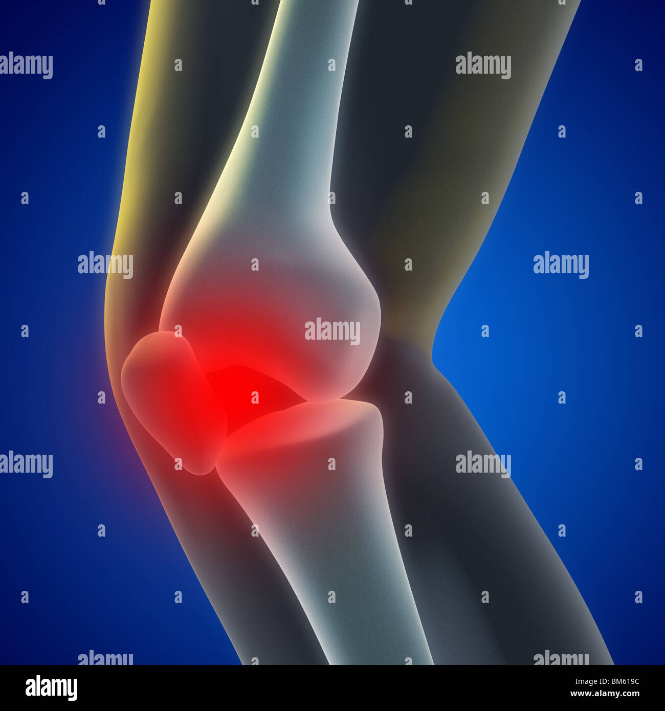 An illustration of a knee xray showing the injury Stock Photo Alamy