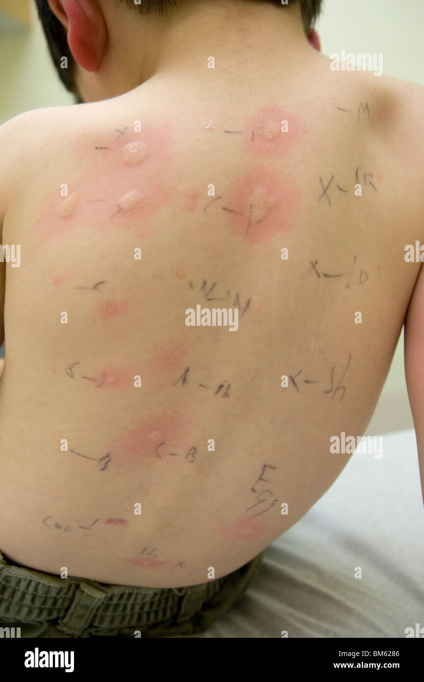 Toddler's back showing skin prick test Stock Photo - Alamy