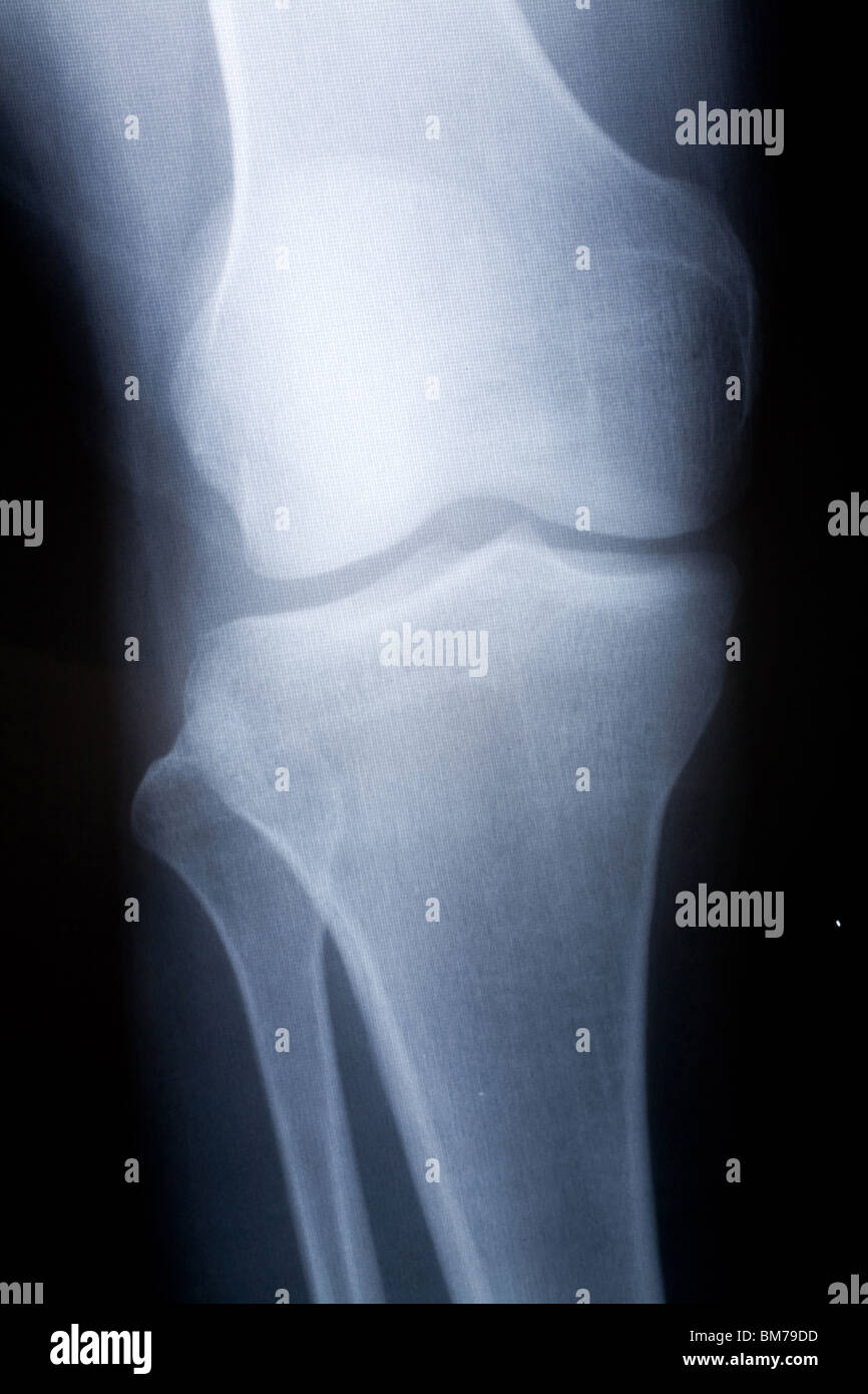 knee x-ray photo for background Stock Photo