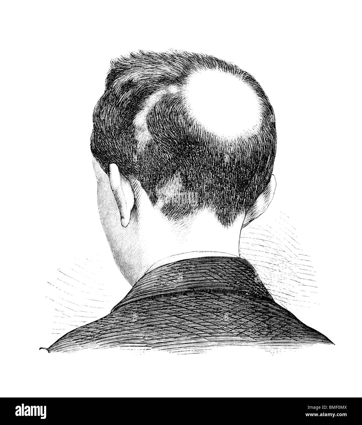 Alopecia areata Stock Photo Alamy