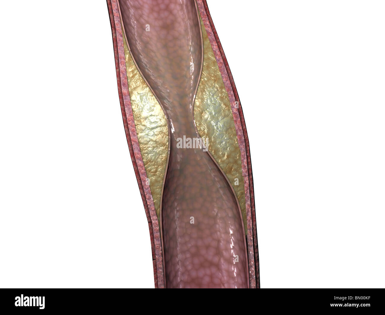 This 3D image depicts a cut away view of the artery with a view of the