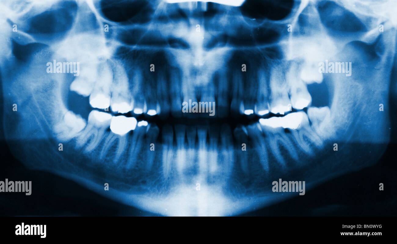 detail of panoramic facial x-ray image Stock Photo