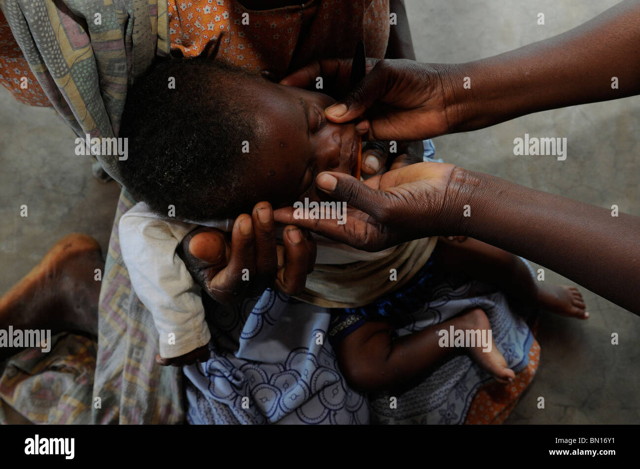 A malnourished toddler is being checked up at a medical center in Malawi Africa Stock Photo