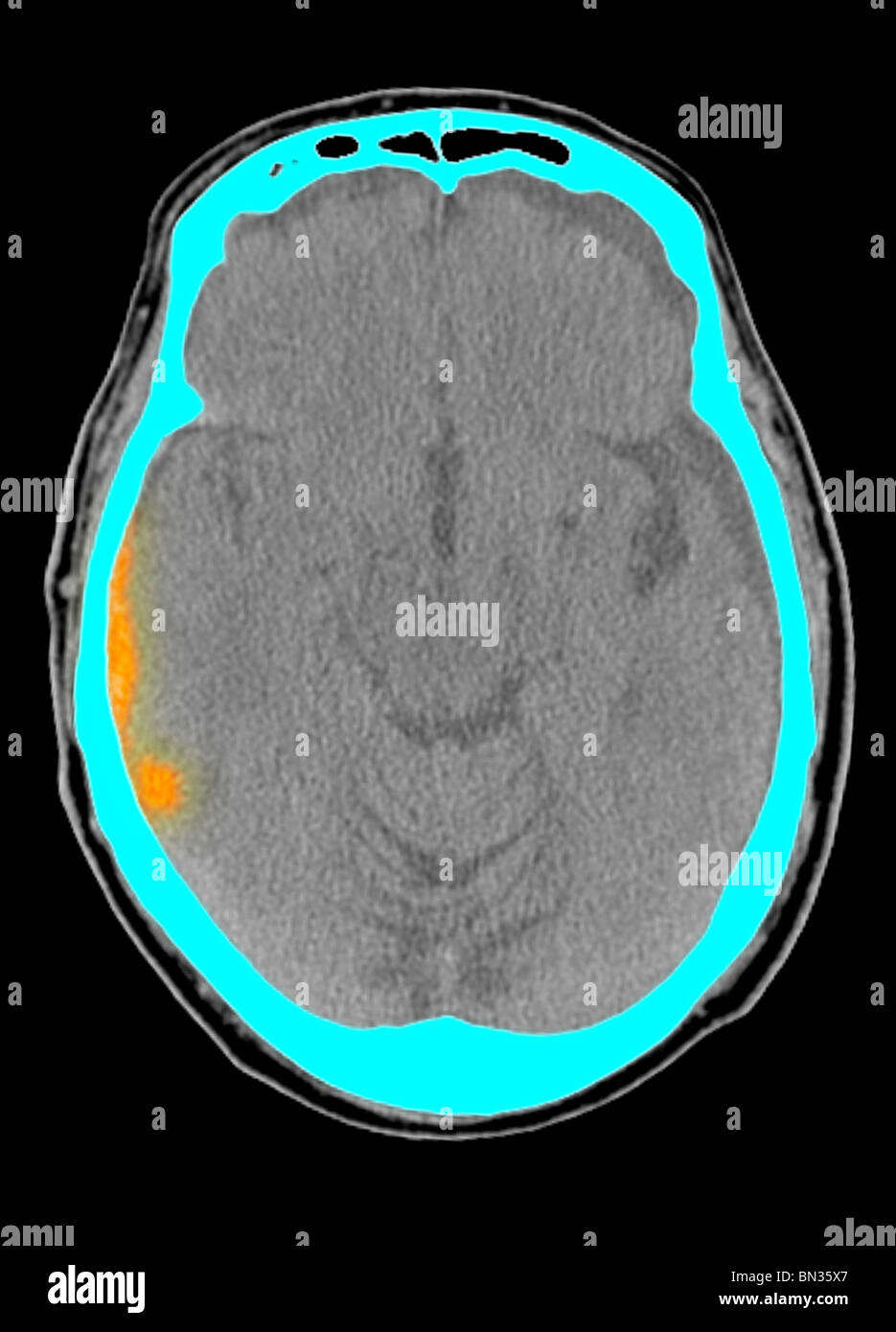 CT scan of the head of a 77 year old man showing acute subdural hematoma Stock Photo