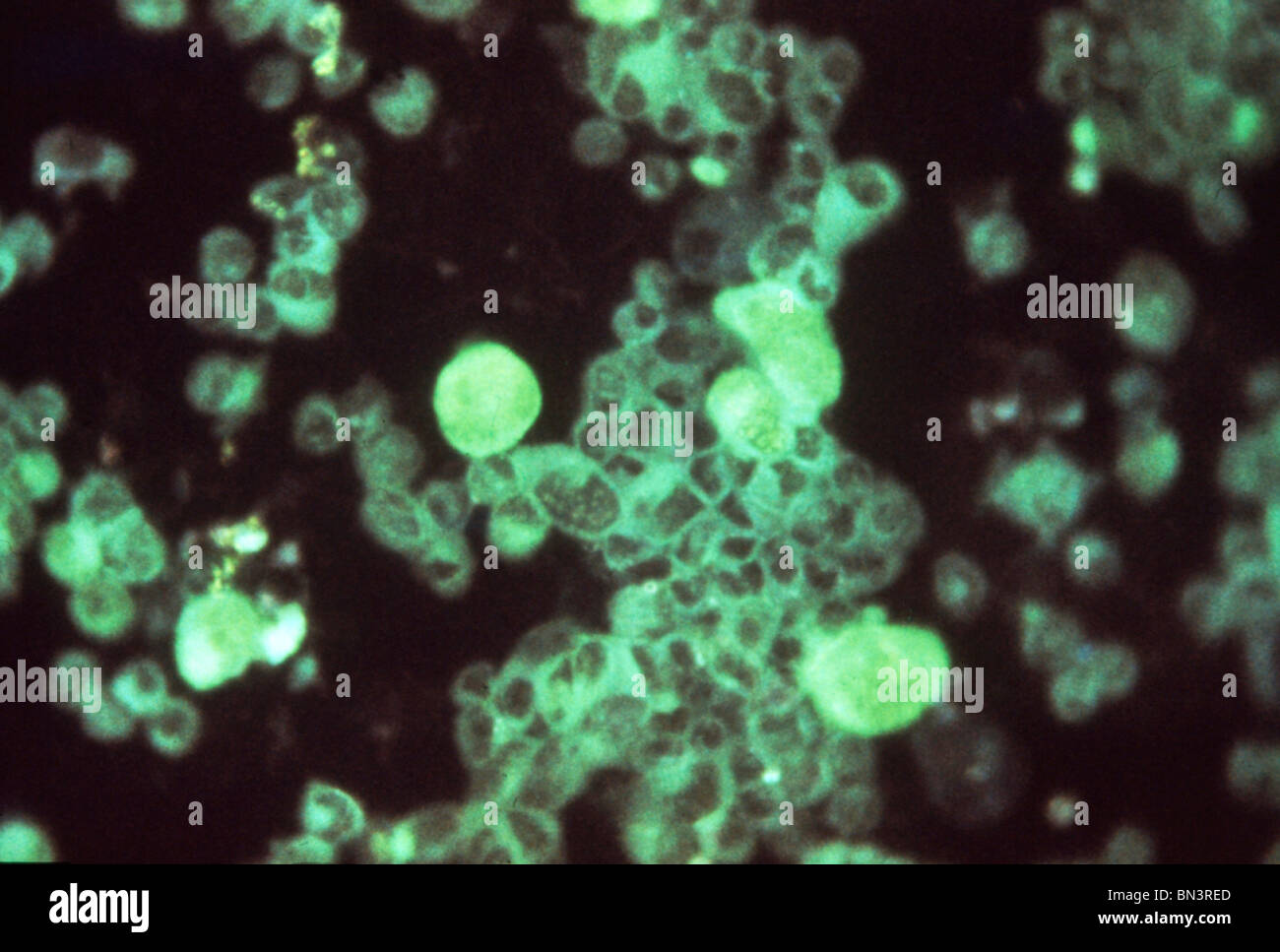 Immunofluorescent staining technique showing cytomegalovirus in human embryonic lung,  at a magnification of 25X Stock Photo