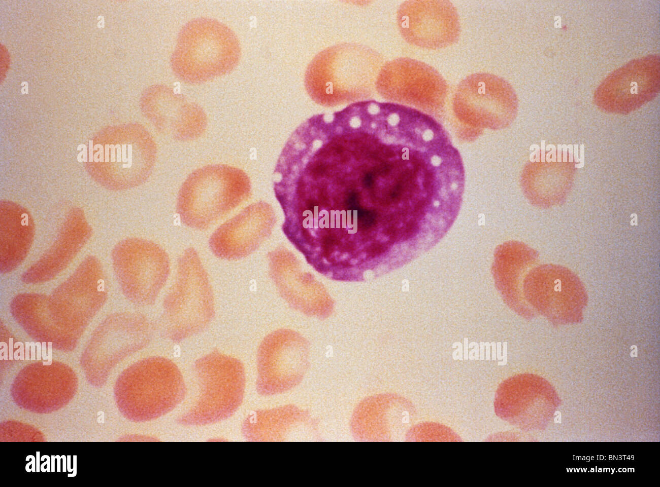 Micrograph of an atypical enlarged lymphocyte found in the blood smear from a patient with Henoch-Schönlein purpura (HPS) Stock Photo