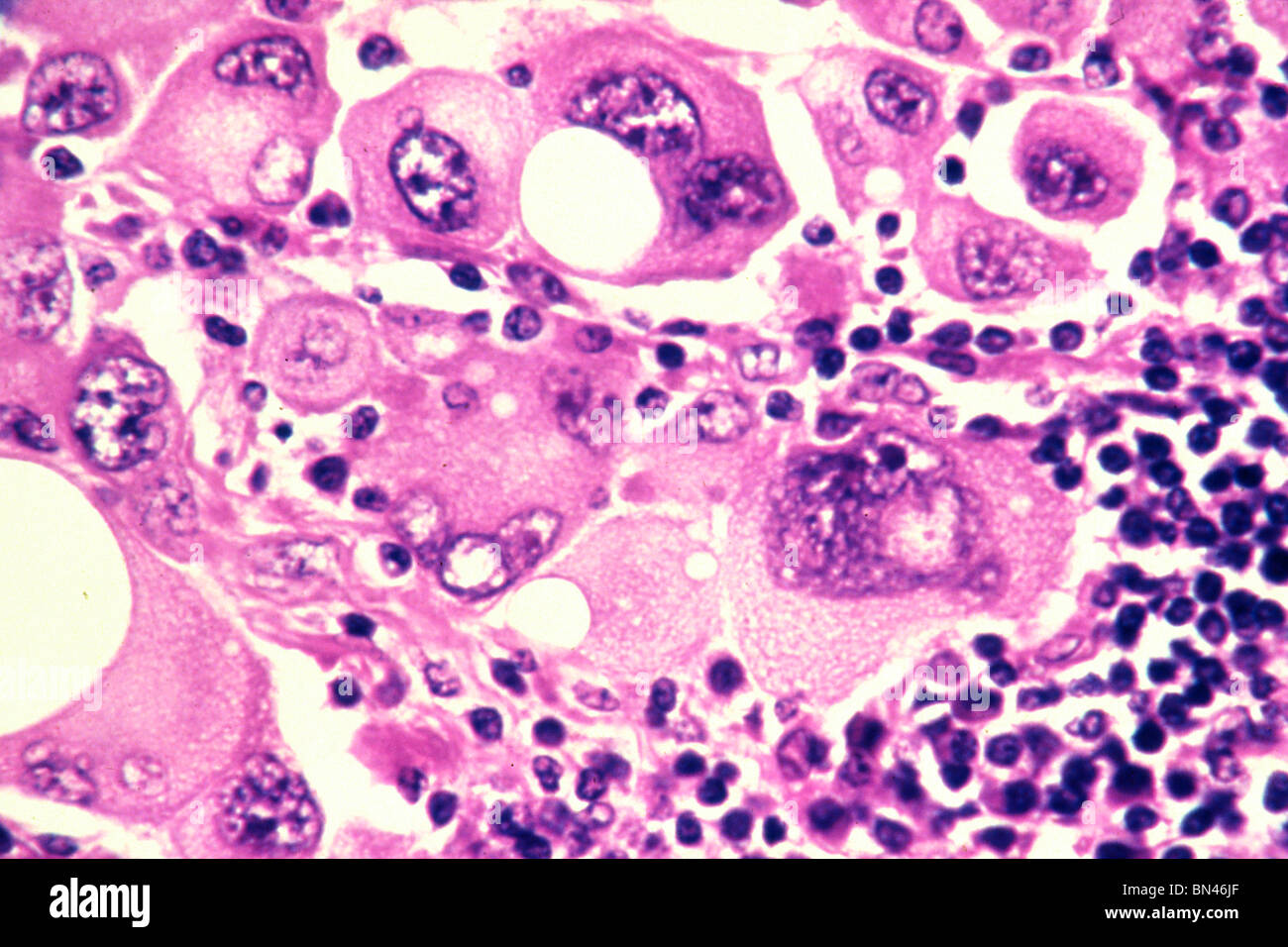 Human metastatic melanoma cells stained with an hematoxylin and eosin (H & E) stain and magnified to 320x Stock Photo