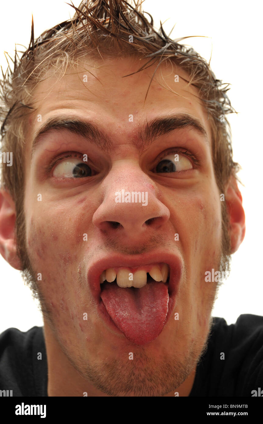 Crazy wacky ugly man with crooked teeth and acne and veins above his eyes Stock Photo