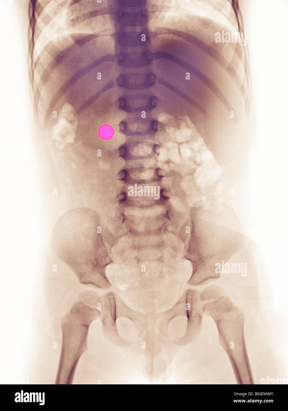 abdomen x-ray of a 3 year old girl who swallowed a watch battery Stock Photo